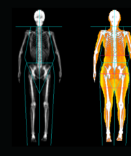 Book an Appointment with Dexa Scanner for DEXA scan